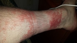My lovely heat and/or wool allergy rash